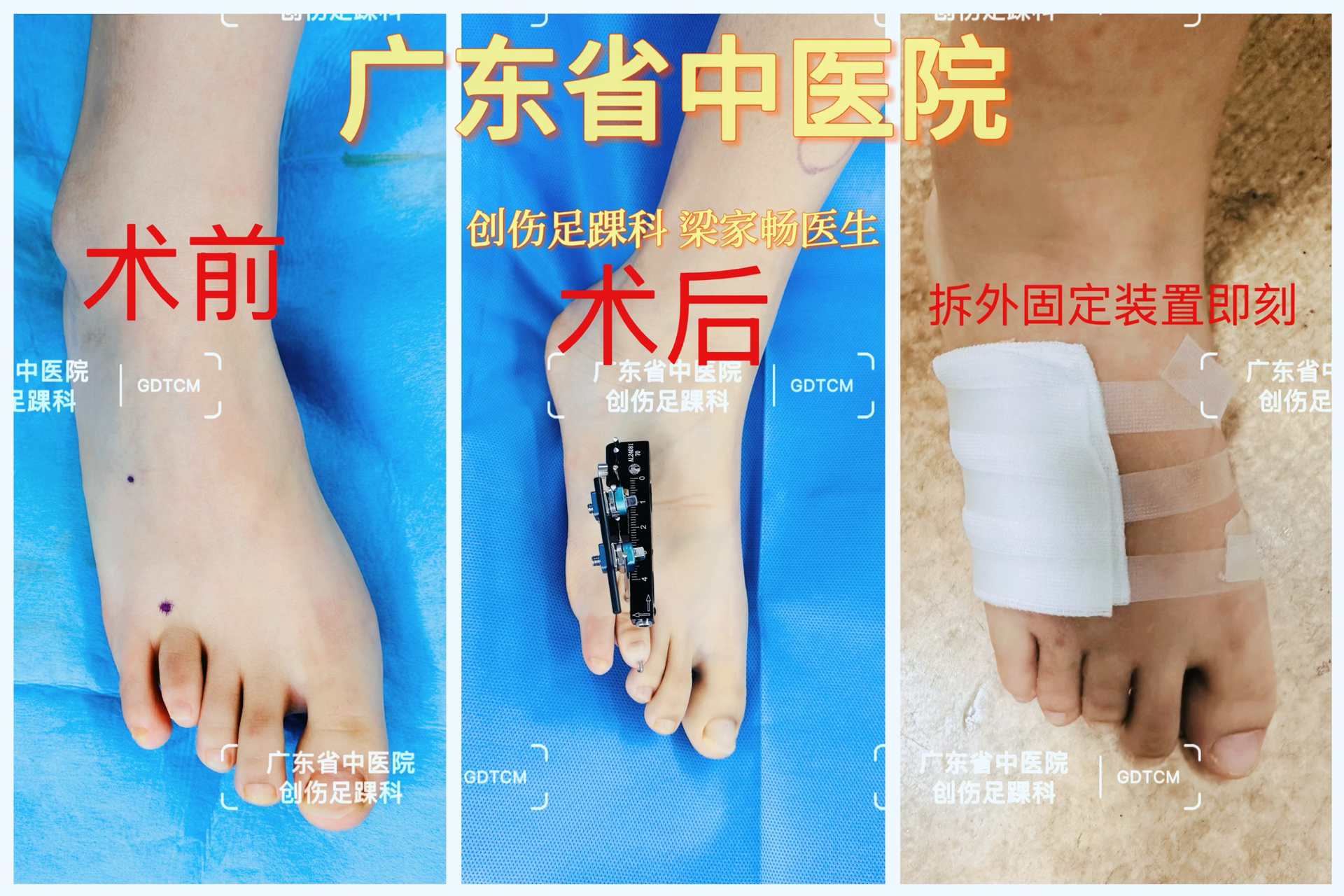 穆西亚拉腓骨骨折手术成功开始进入恢复阶段的简单介绍 第2张 穆西亚拉腓骨骨折手术成功开始进入恢复阶段的简单介绍 第2张